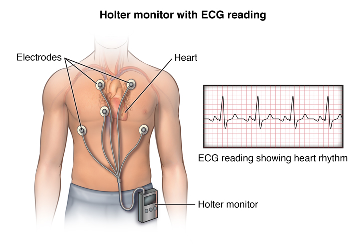 estudio holter